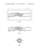 Method Of Sizing Internal Body Structure, And Mechanism And System For     Same diagram and image