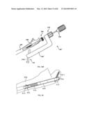 STRAIGHT INTRAMEDULLARY FRACTURE FIXATION DEVICES AND METHODS diagram and image