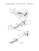 STRAIGHT INTRAMEDULLARY FRACTURE FIXATION DEVICES AND METHODS diagram and image