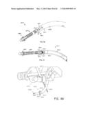 STRAIGHT INTRAMEDULLARY FRACTURE FIXATION DEVICES AND METHODS diagram and image