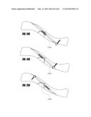 STRAIGHT INTRAMEDULLARY FRACTURE FIXATION DEVICES AND METHODS diagram and image