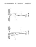 NAVIGATION INSTRUMENTS FOR SUBCHONDRAL BONE TREATMENT diagram and image