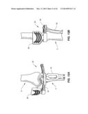 NAVIGATION INSTRUMENTS FOR SUBCHONDRAL BONE TREATMENT diagram and image