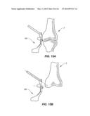 NAVIGATION INSTRUMENTS FOR SUBCHONDRAL BONE TREATMENT diagram and image