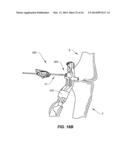 NAVIGATION INSTRUMENTS FOR SUBCHONDRAL BONE TREATMENT diagram and image