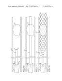 RETRIEVAL CATHETER WITH EXPANDABLE TIP diagram and image