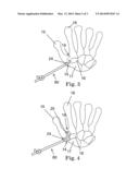 JOINT RECONSTRUCTION SYSTEM AND METHOD diagram and image