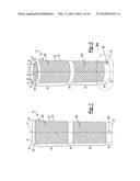 Implant Sleeve For Orthopedic Implants diagram and image