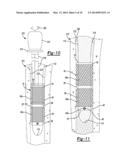 Implant Sleeve For Orthopedic Implants diagram and image