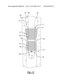Implant Sleeve For Orthopedic Implants diagram and image