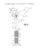 Implant Sleeve For Orthopedic Implants diagram and image