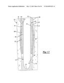 Implant Sleeve For Orthopedic Implants diagram and image