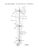 PREOPERATIVELY PLANNING AN ARTHROPLASTY PROCEDURE AND GENERATING A     CORRESPONDING PATIENT SPECIFIC ARTHROPLASTY RESECTION GUIDE diagram and image