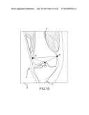 PREOPERATIVELY PLANNING AN ARTHROPLASTY PROCEDURE AND GENERATING A     CORRESPONDING PATIENT SPECIFIC ARTHROPLASTY RESECTION GUIDE diagram and image