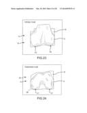 PREOPERATIVELY PLANNING AN ARTHROPLASTY PROCEDURE AND GENERATING A     CORRESPONDING PATIENT SPECIFIC ARTHROPLASTY RESECTION GUIDE diagram and image