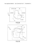 PREOPERATIVELY PLANNING AN ARTHROPLASTY PROCEDURE AND GENERATING A     CORRESPONDING PATIENT SPECIFIC ARTHROPLASTY RESECTION GUIDE diagram and image