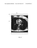 Method and System for Correction of Lung Density Variation in Positron     Emission Tomography Using Magnetic Resonance Imaging diagram and image