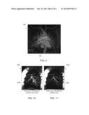 Method and System for Correction of Lung Density Variation in Positron     Emission Tomography Using Magnetic Resonance Imaging diagram and image