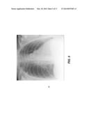 RIB SUPPRESSION IN RADIOGRAPHIC IMAGES diagram and image