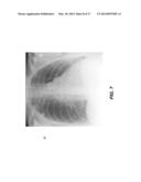 RIB SUPPRESSION IN RADIOGRAPHIC IMAGES diagram and image