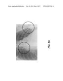 RIB SUPPRESSION IN RADIOGRAPHIC IMAGES diagram and image