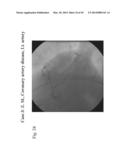 ANALYSIS OF ELECTROCARDIOGRAM SIGNALS diagram and image