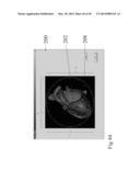 ANALYSIS OF ELECTROCARDIOGRAM SIGNALS diagram and image