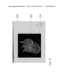 ANALYSIS OF ELECTROCARDIOGRAM SIGNALS diagram and image