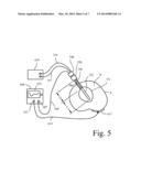 Cool RF Electrode diagram and image