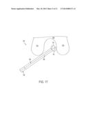 LOW PROFILE REAMERS AND METHODS OF USE diagram and image