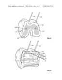 Patient-Specific Orthopedic Instruments diagram and image