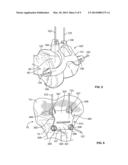 Patient-Specific Orthopedic Instruments diagram and image