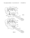 Patient-Specific Orthopedic Instruments diagram and image