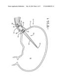 ENDOLUMENAL RESTRICTION METHOD AND APPARATUS diagram and image