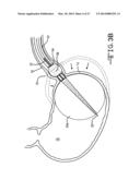 ENDOLUMENAL RESTRICTION METHOD AND APPARATUS diagram and image