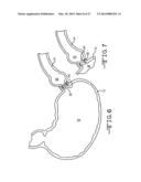 ENDOLUMENAL RESTRICTION METHOD AND APPARATUS diagram and image