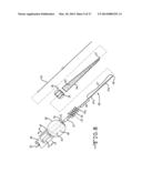 ENDOLUMENAL RESTRICTION METHOD AND APPARATUS diagram and image