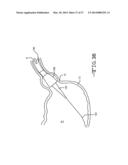 ENDOLUMENAL RESTRICTION METHOD AND APPARATUS diagram and image