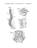 Crossbar Spinal Prosthesis Having A Modular Design and Related     ImplantationMethods diagram and image