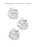 Crossbar Spinal Prosthesis Having A Modular Design and Related     ImplantationMethods diagram and image