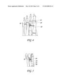 METHOD AND DEVICE FOR CORRECTING BONE DEFORMITIES diagram and image