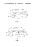 METHOD AND DEVICE FOR CORRECTING BONE DEFORMITIES diagram and image