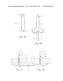 FASTENING SYSTEM FOR INTERNAL FIXATION diagram and image