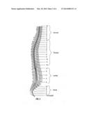 METHOD OF NEUROSTIMULATION OF DISTINCT NEURAL STRUCTURES USING SINGLE     PADDLE LEAD TO TREAT MULTIPLE PAIN LOCATIONS AND MULTI-COLUMN, MULTI-ROW     PADDLE LEAD FOR SUCH NEUROSTIMULATION diagram and image