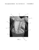 Reusable Packaging Bag for Absorbent Articles diagram and image