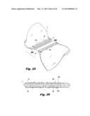 INTERLOCKING BUTTRESS MATERIAL RETENTION SYSTEM diagram and image