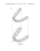 TOOTH MOVEMENT MEASUREMENT BY AUTOMATIC IMPRESSION MATCHING diagram and image