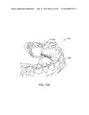 TOOTH MOVEMENT MEASUREMENT BY AUTOMATIC IMPRESSION MATCHING diagram and image