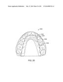 TOOTH MOVEMENT MEASUREMENT BY AUTOMATIC IMPRESSION MATCHING diagram and image