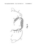 IMPLANTS, TOOLS, AND METHODS FOR TREATMENT OF PELVIC CONDITIONS diagram and image